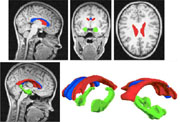 Top Row- Three views of brain MRI images with the extracted brain structures highlighted.
 
Bottom Row- MRI image with extracted brain structures (bottom left), two different close-up views of extracted brain structures (bottom middle and bottom right).